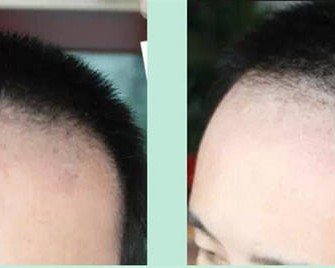 西安植发:头发移植术前需注意什么事项?