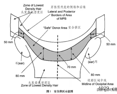 西安植发机构排行，一张图搞明白你植发需要多少钱？