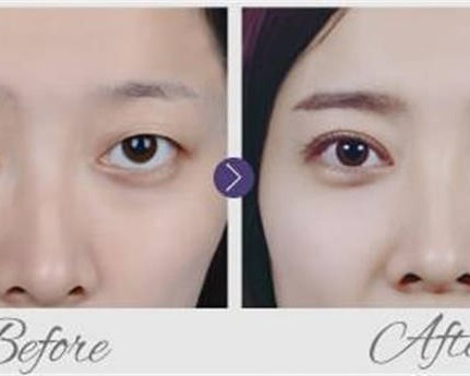 西安三点定位双眼皮手术医院哪家好？